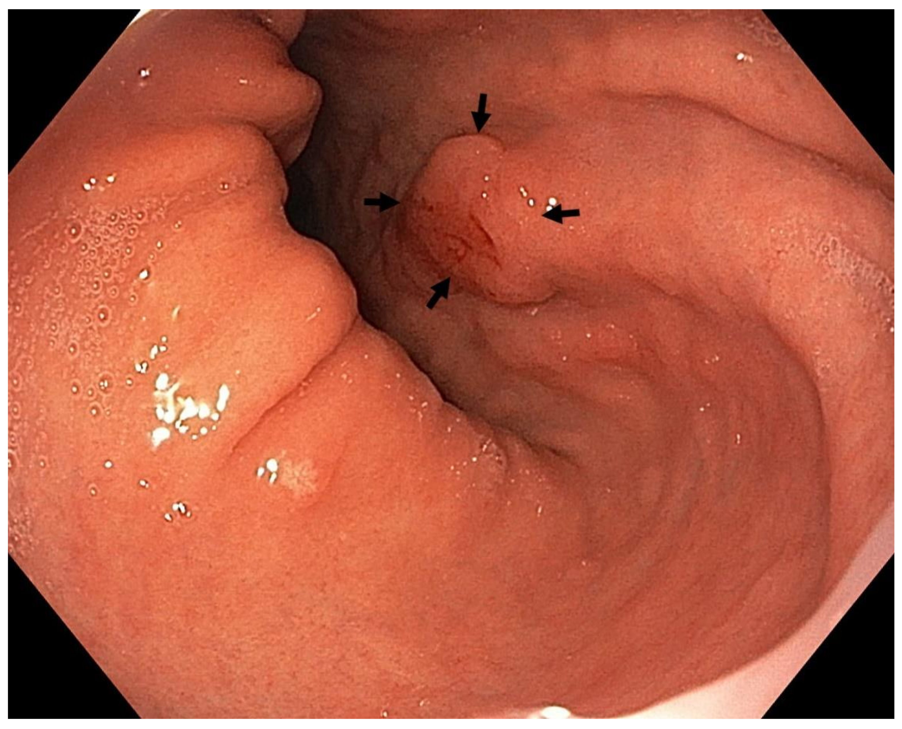 Cancers | Free Full-Text | Advances In The Aetiology &amp;Amp; Endoscopic  Detection And Management Of Early Gastric Cancer | Html