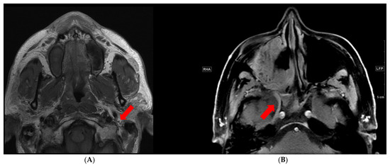 adenoid cystic carcinoma mri édesgyökér prosztatitis