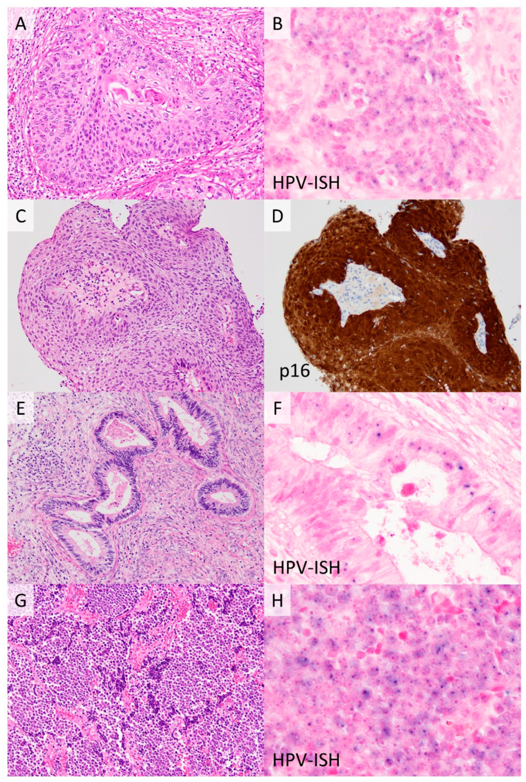 Diagnosticul cancerului de col uterin – cervical, Condilom cervical ce