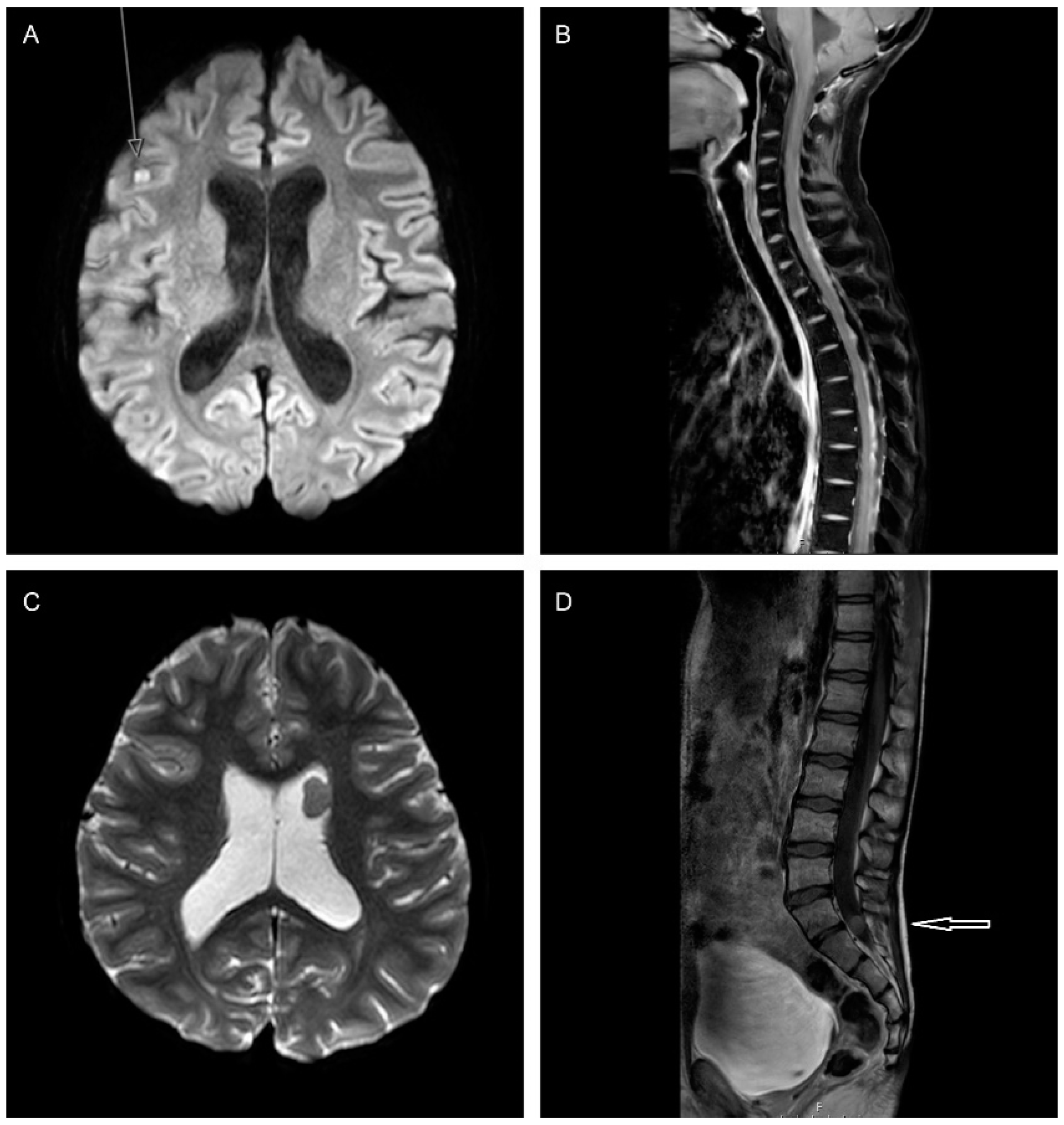 Cancers Free Full-Text | Relapsed Medulloblastoma in Pre-Irradiated Patients: Current Practice Diagnostics and Treatment