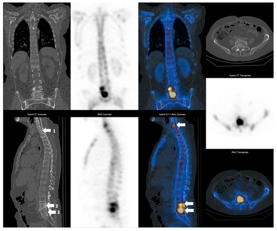 Quantitative Analysis of SPECT-CT Data in Metastatic Breast Cancer ...