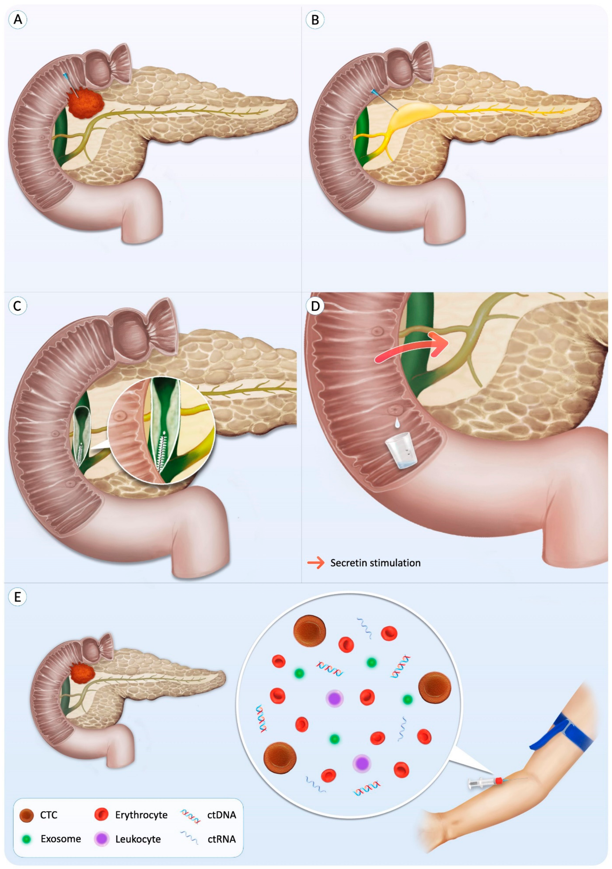 Evaluating Pancreatic and Biliary Neoplasms with Small