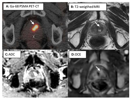 Value of Targeted Biopsies and Combined PSMA PET/CT and mp-MRI Imaging ...