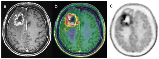 What Does PET Imaging Bring to Neuro-Oncology in 2022? A Review