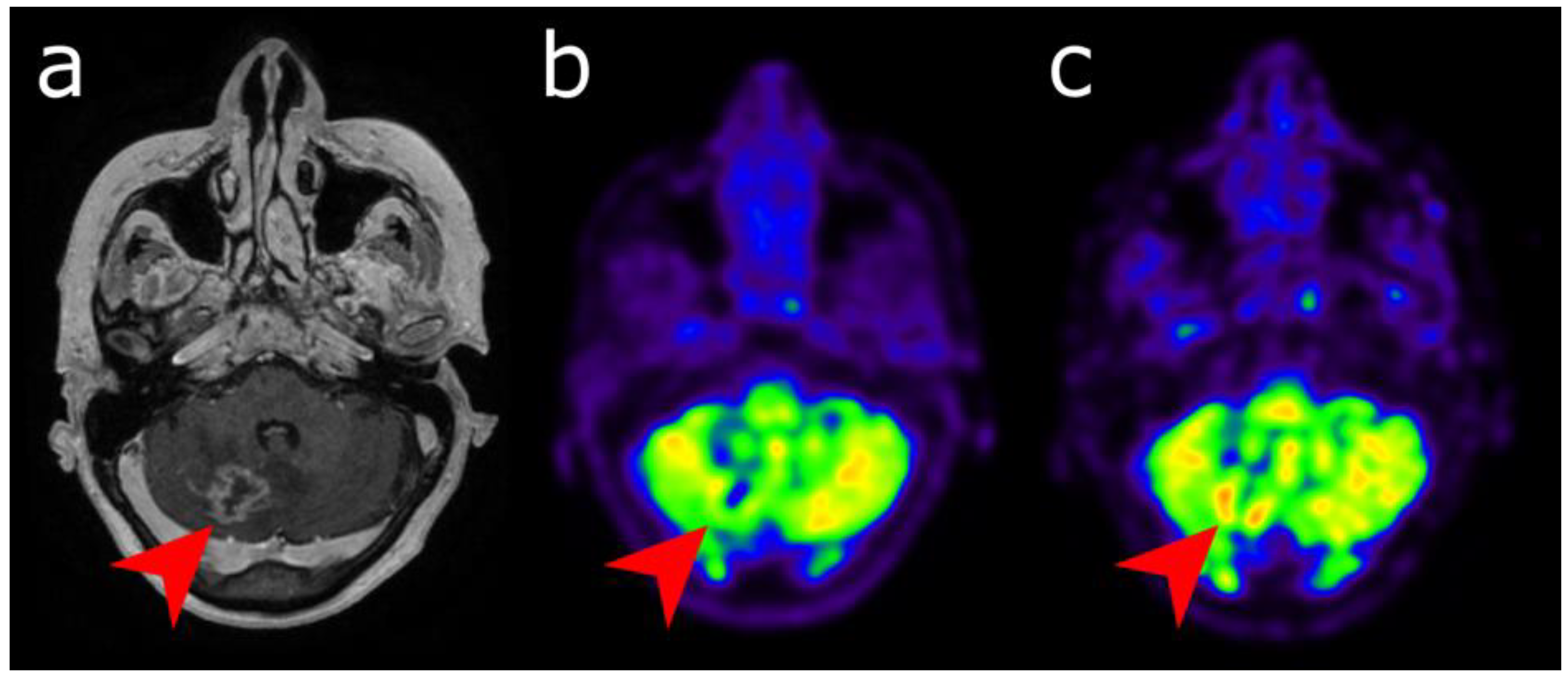 What Does PET Imaging Bring to Neuro-Oncology in 2022? A Review