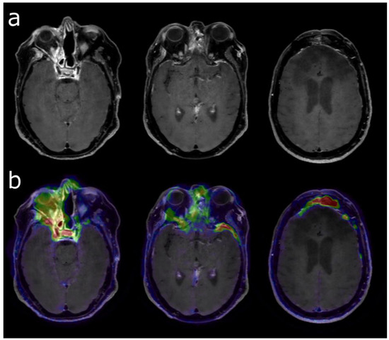 健康・医学 PET in Clinical Oncology PET Imaging in Clinical Oncology | SpringerLink