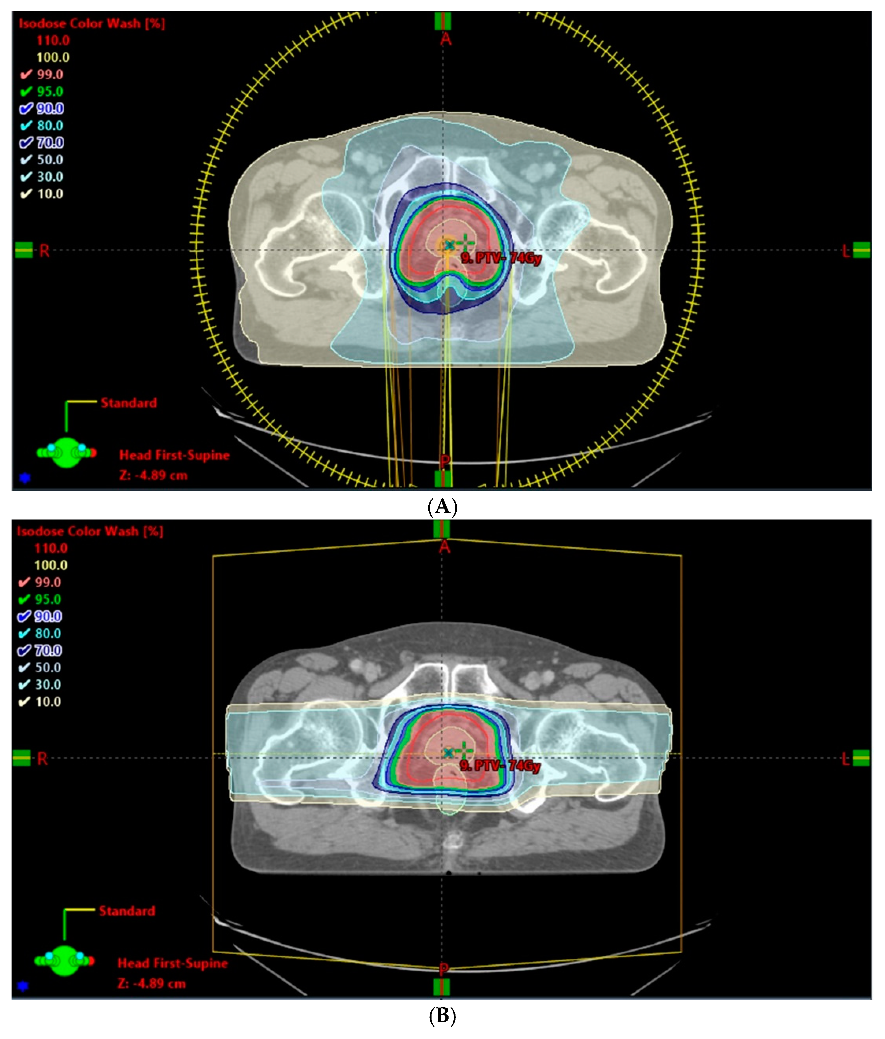 Cancers | Free Full-Text | Proton Therapy For Prostate Cancer: Challenges  And Opportunities