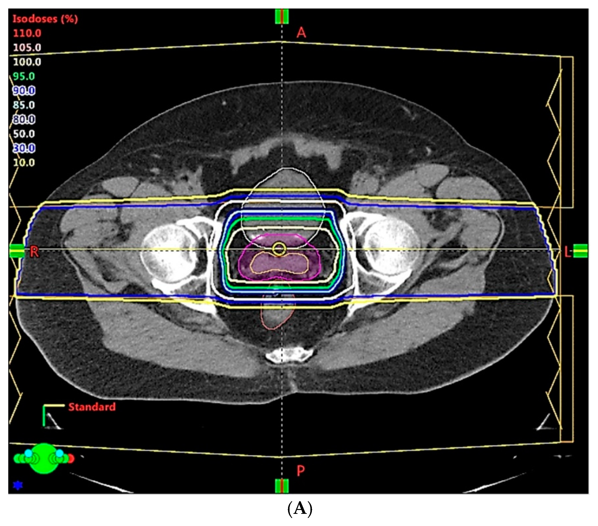 Cancers | Free Full-Text | Proton Therapy For Prostate Cancer: Challenges  And Opportunities