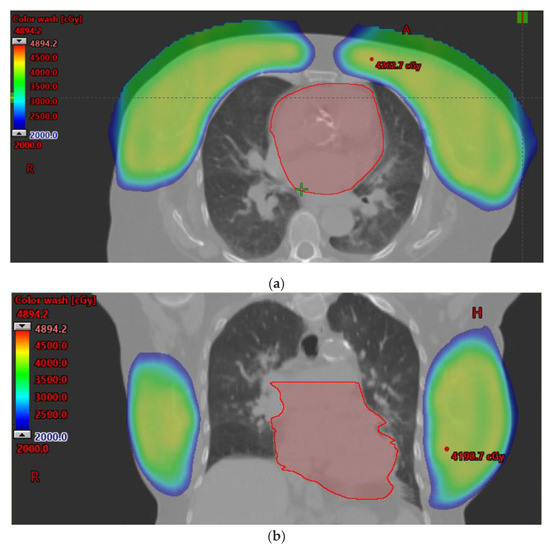 健康・医学 Radiotherapy Techniques in Breast Cancer Frontiers | Comparison of Breast Cancer Radiotherapy