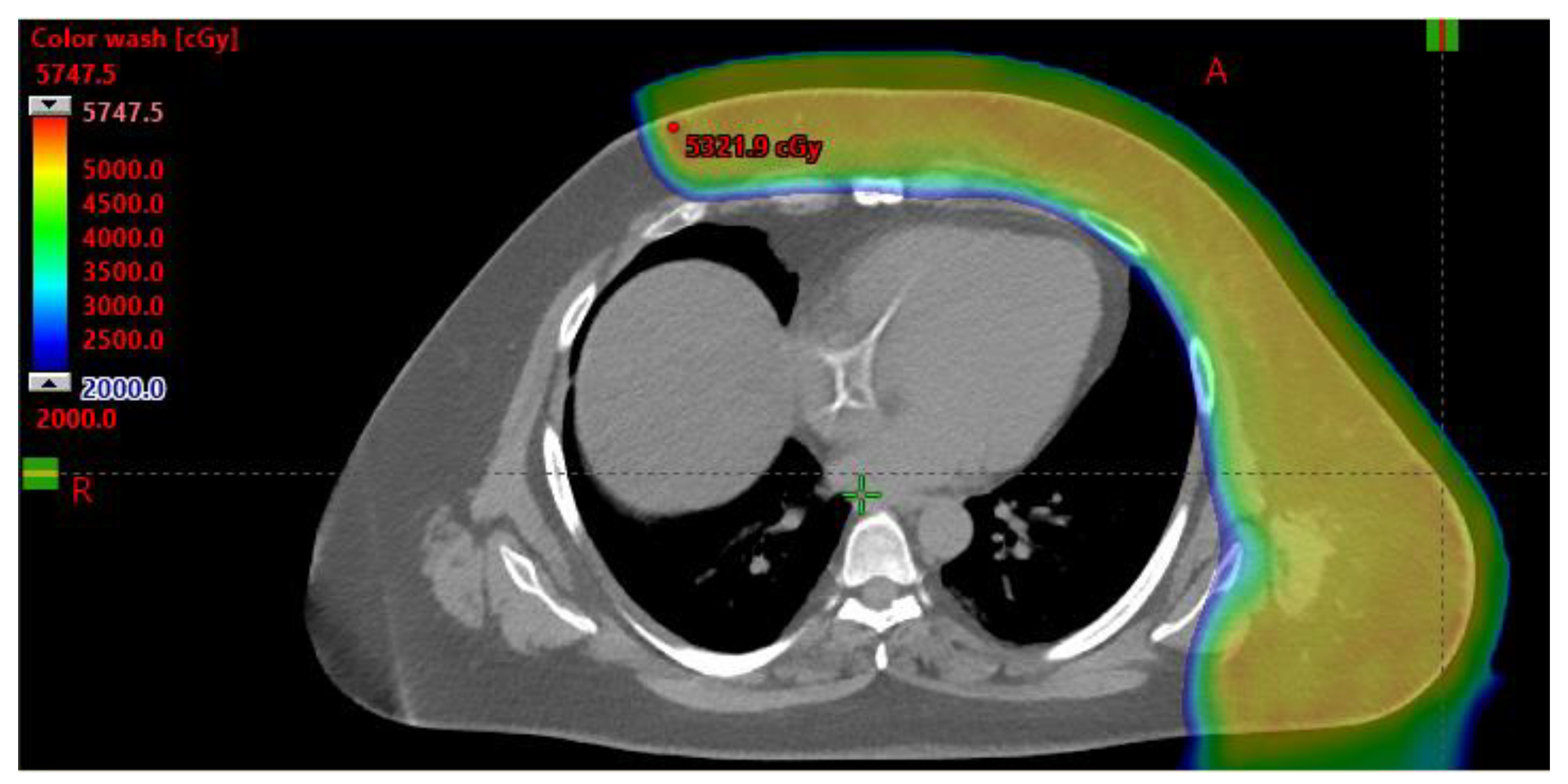 健康・医学 Radiotherapy Techniques in Breast Cancer Frontiers | Comparison of Breast Cancer Radiotherapy
