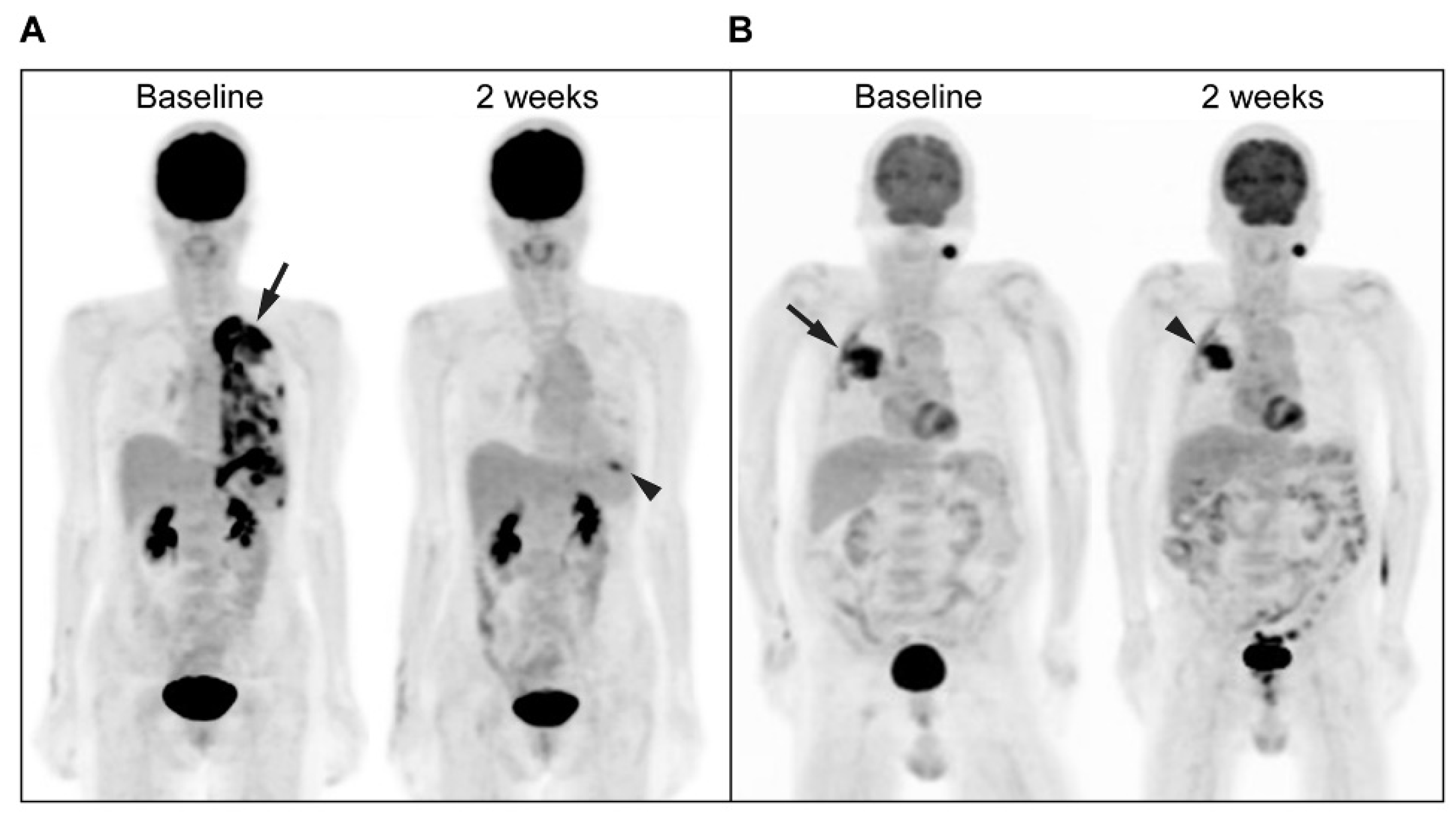 Pet Scan Images Lung Cancer