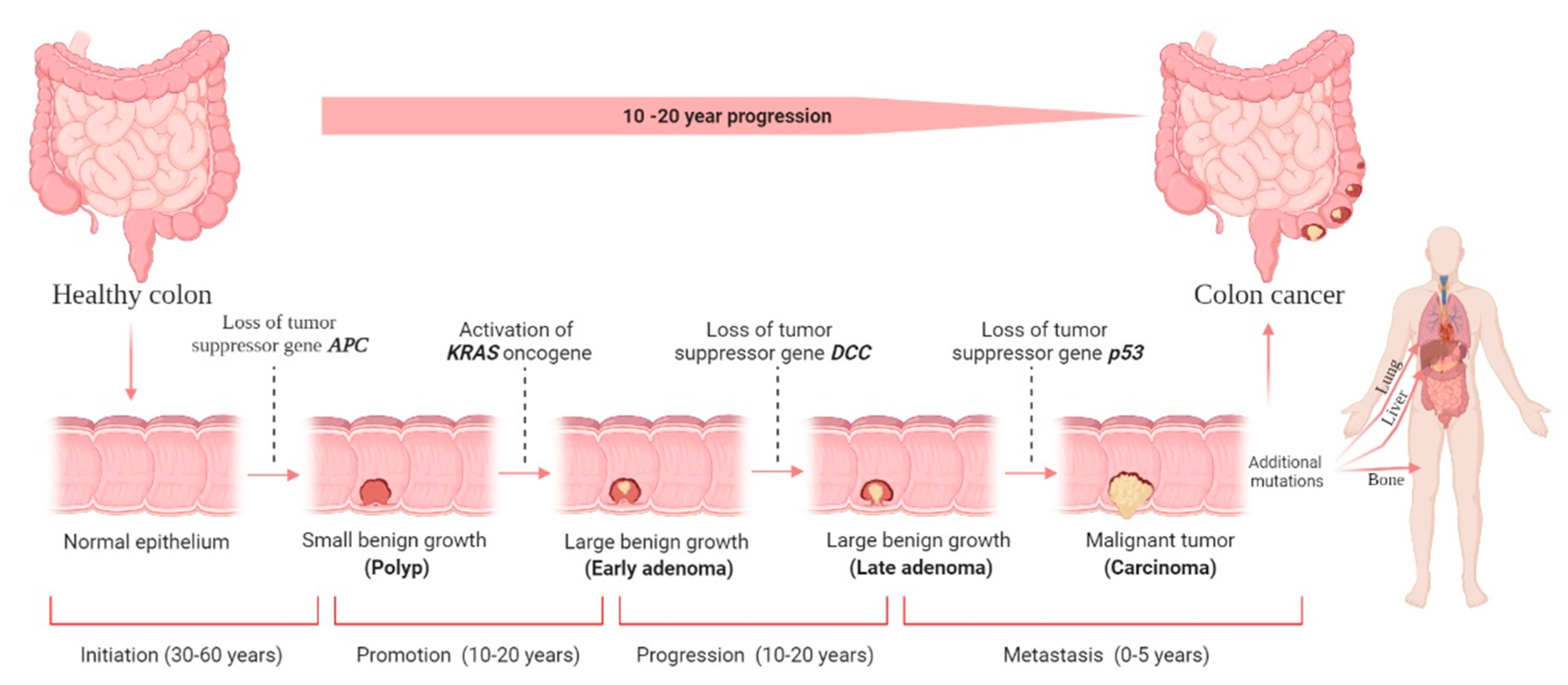 Colorectal Cancer Pathophysiology