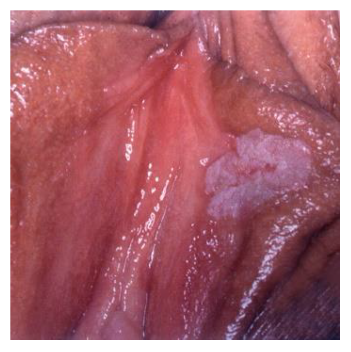 vestibularis papillomatosis vagy herpesz