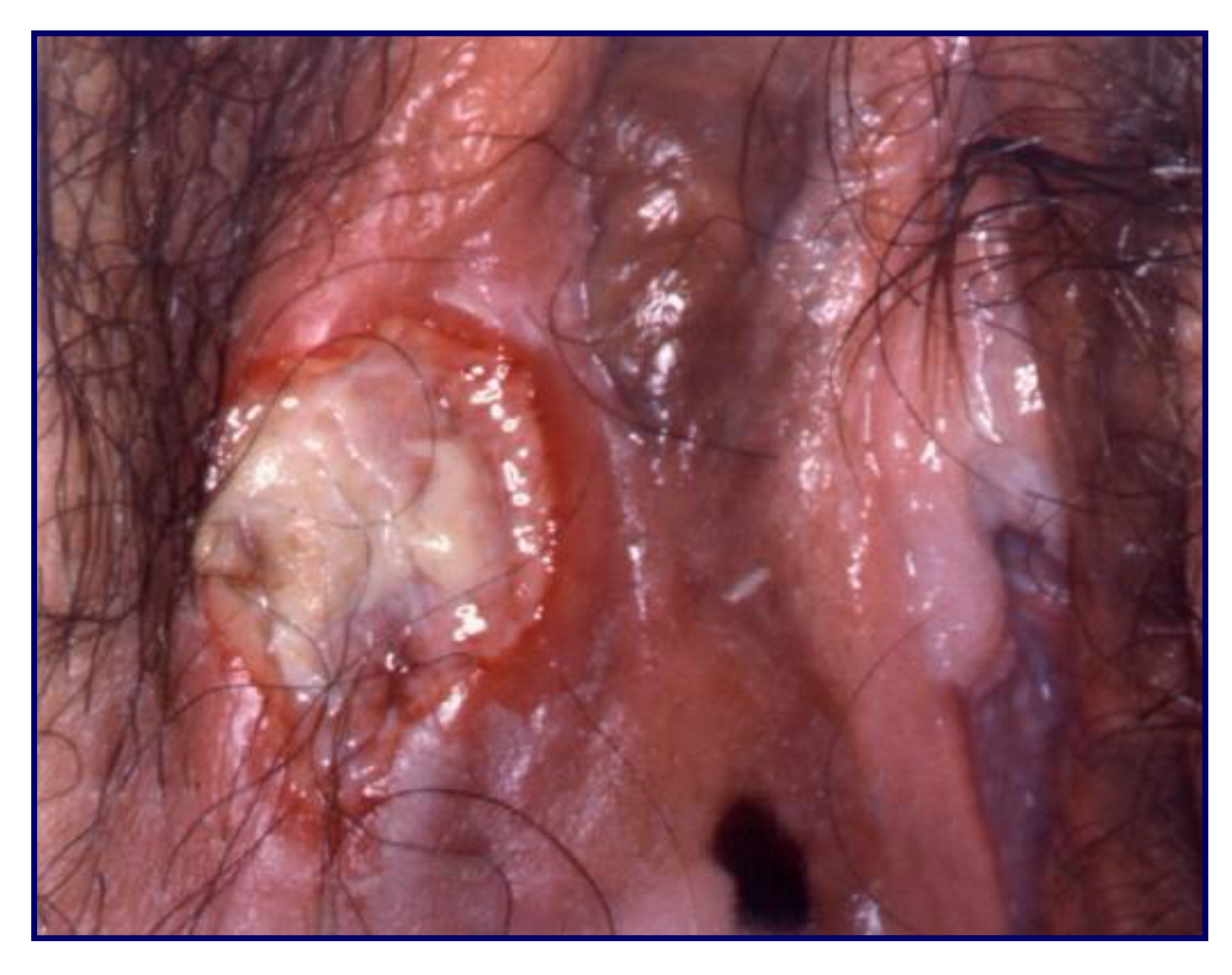 Cancers | Free Full-Text | Early Diagnostics of Vulvar Intraepithelial  Neoplasia