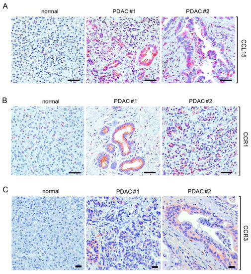 Oncogenic Kras-Mediated Cytokine CCL15 Regulates Pancreatic Cancer
