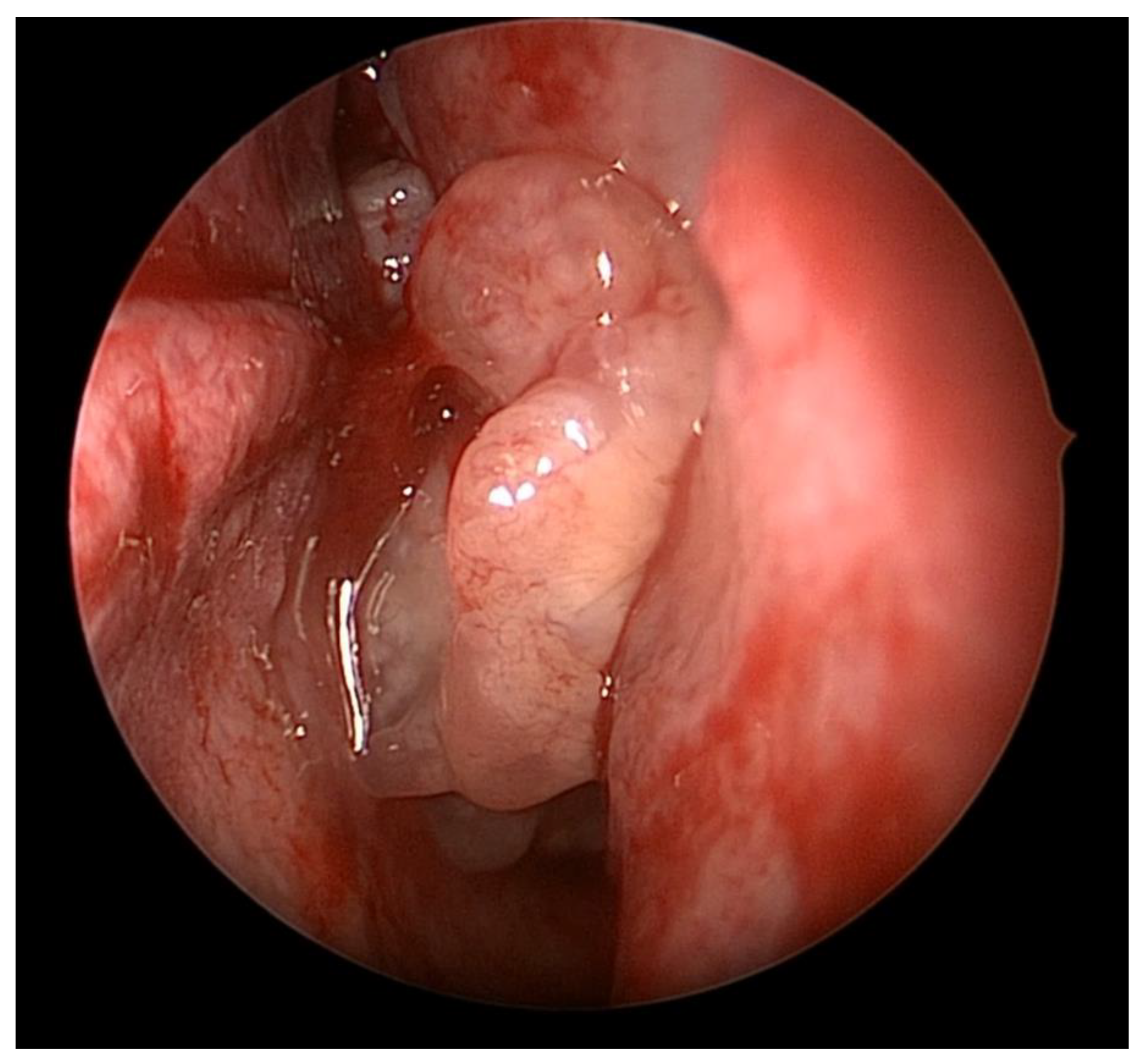 nasal papilloma