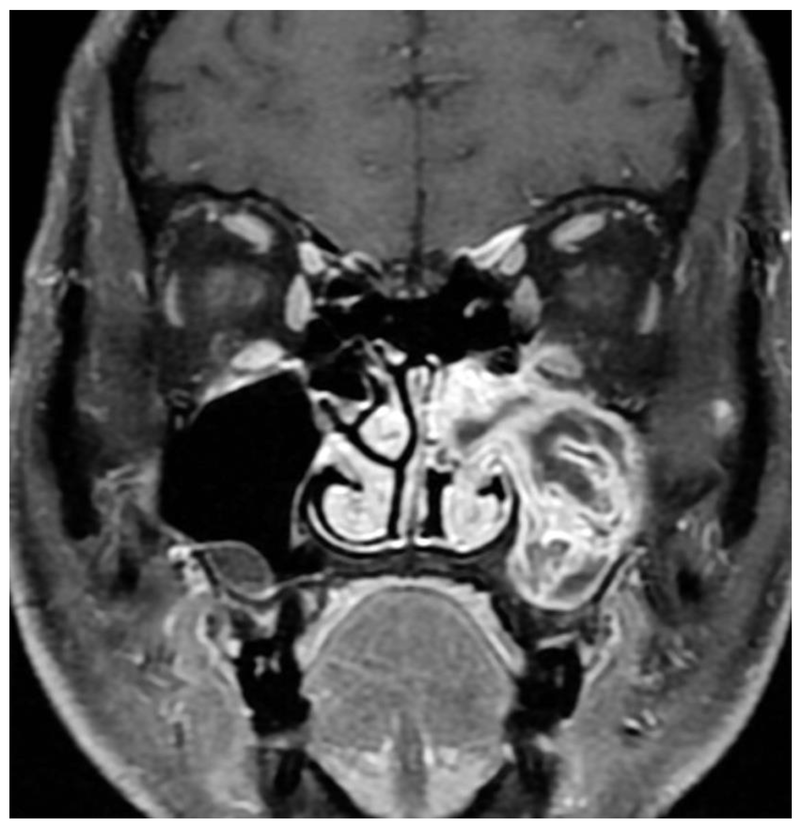 nasal papilloma