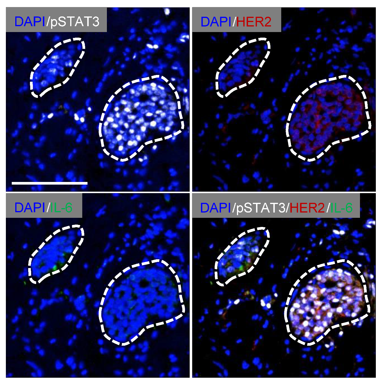 Cancers Free Full Text Paracrine Il 6 Signaling Confers Proliferation Between Heterogeneous Inflammatory Breast Cancer Sub Clones Html