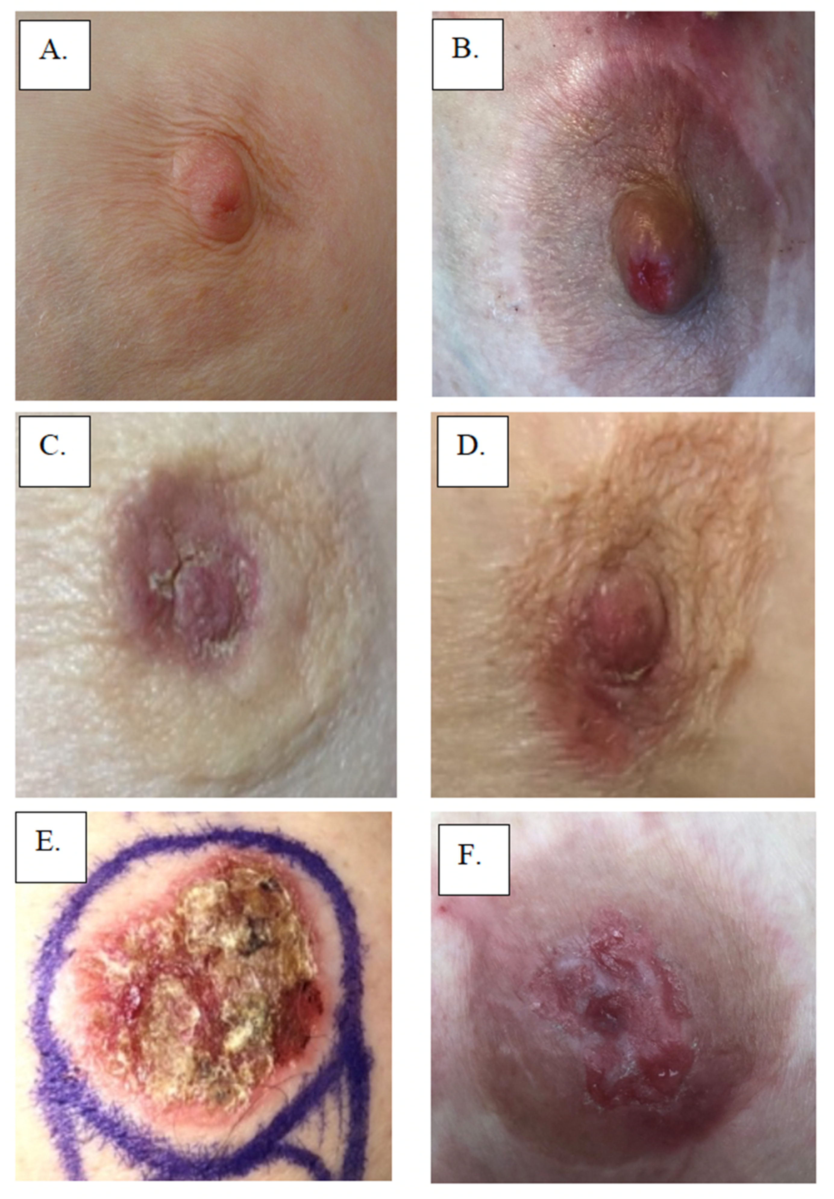 Cancers | Free Full-Text | Mammary Paget&rsquo;s Disease: An Update