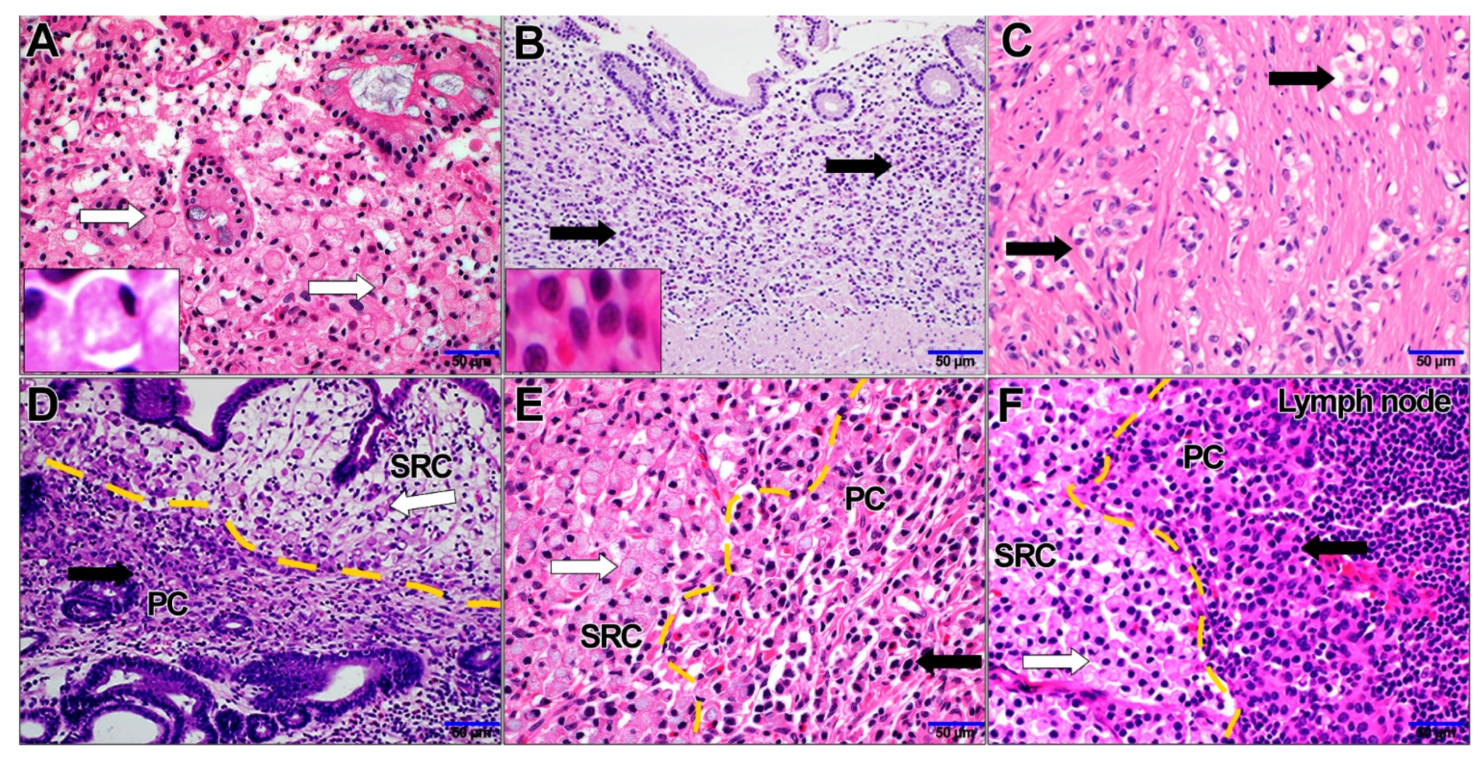 Metastatic Signet Ring Cell Adenocarcinoma—An Autopsy Finding in  Myocardium: A Rare Case Report