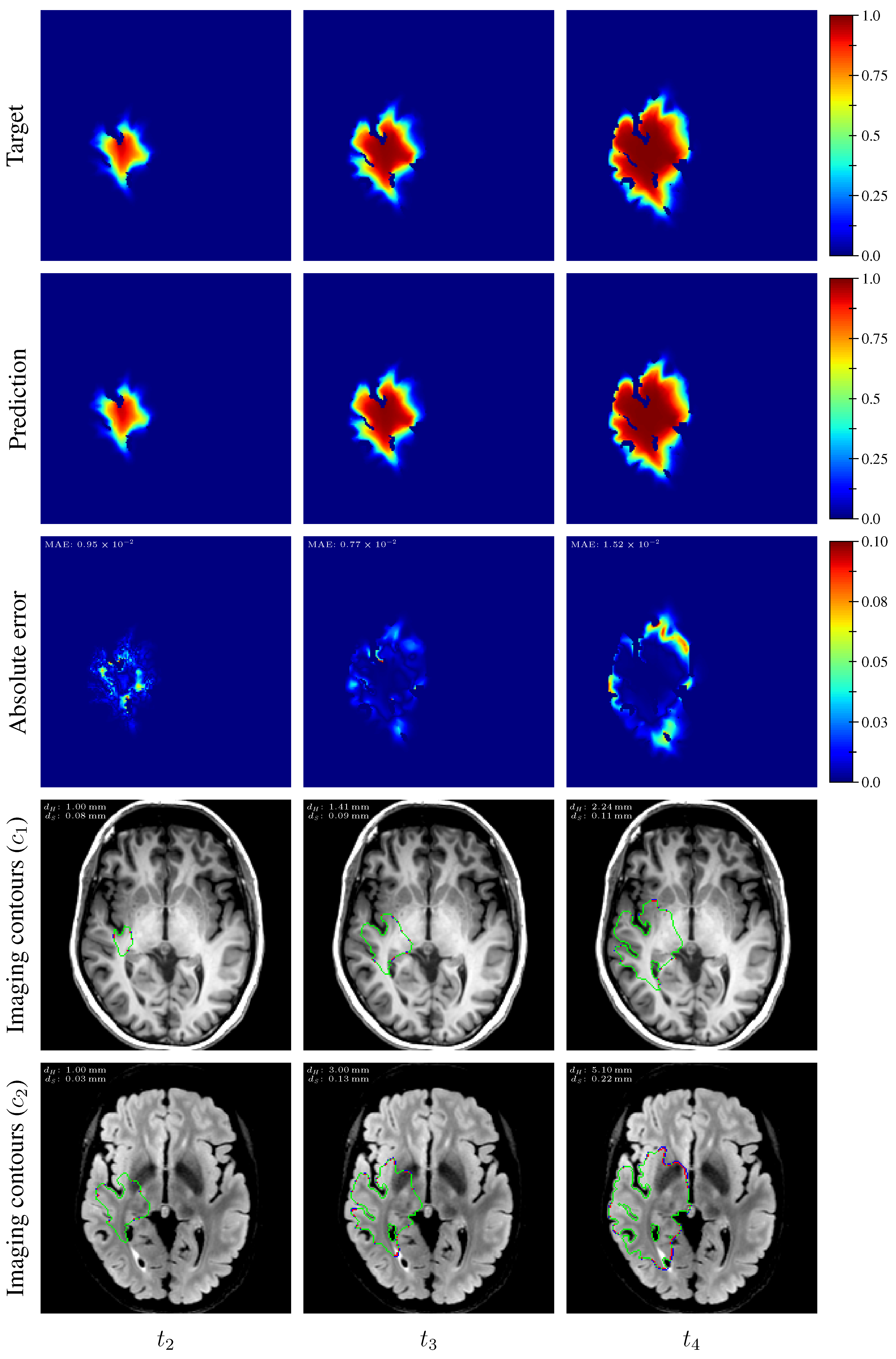 Deep Learning for Reaction-Diffusion Glioma Growth Modeling: Towards a ...
