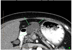 Cancers 14 02539 i001