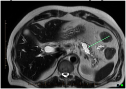 Cancers 14 02539 i003