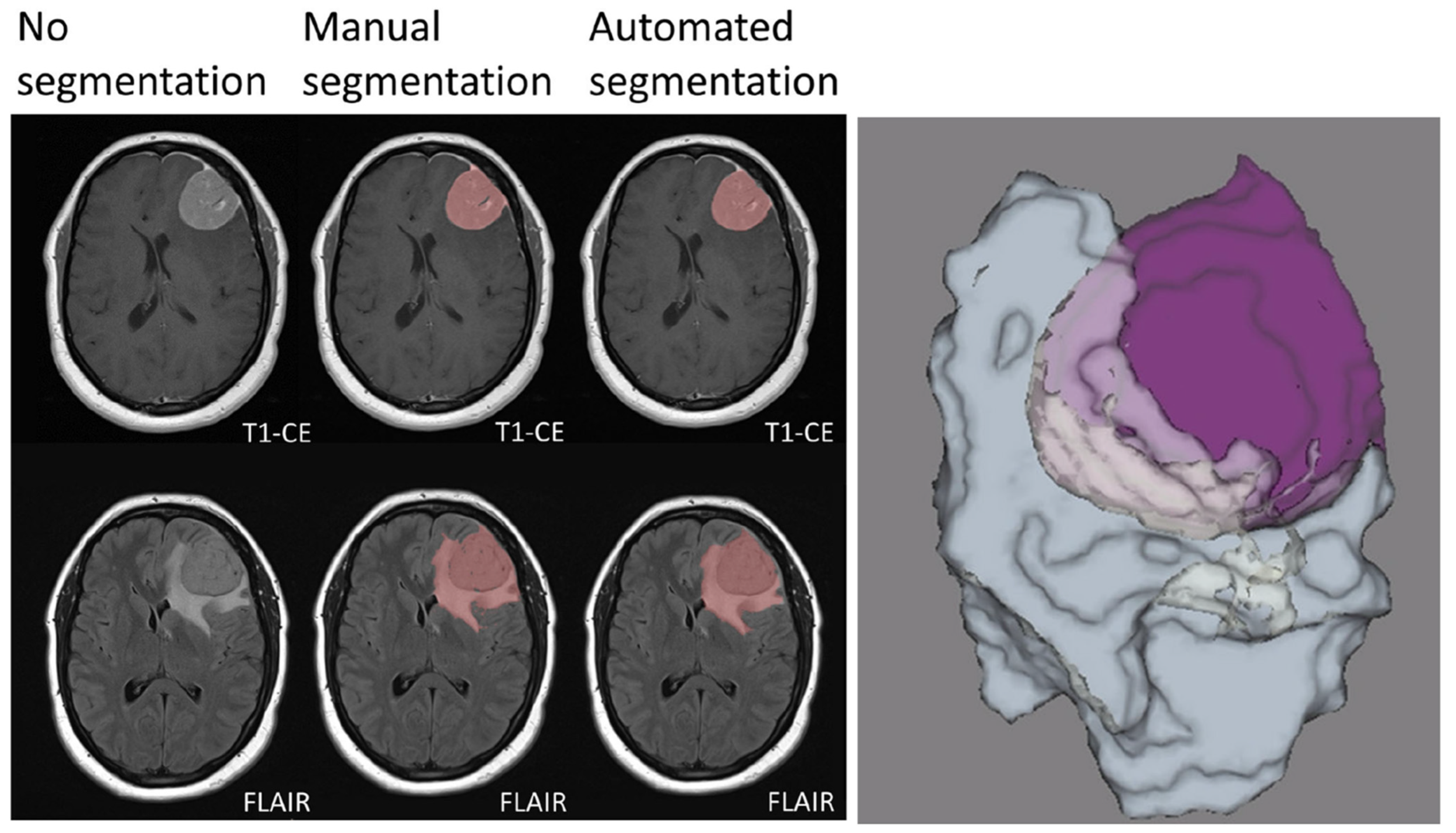 NEXUS score vs CT scan findings.