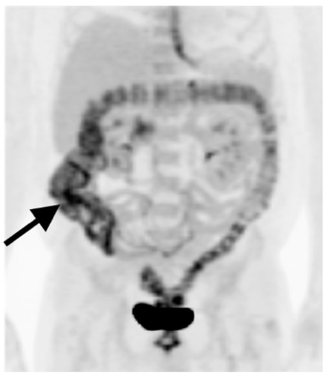 PET-CT in Clinical Adult Oncology: III. Gastrointestinal Malignancies