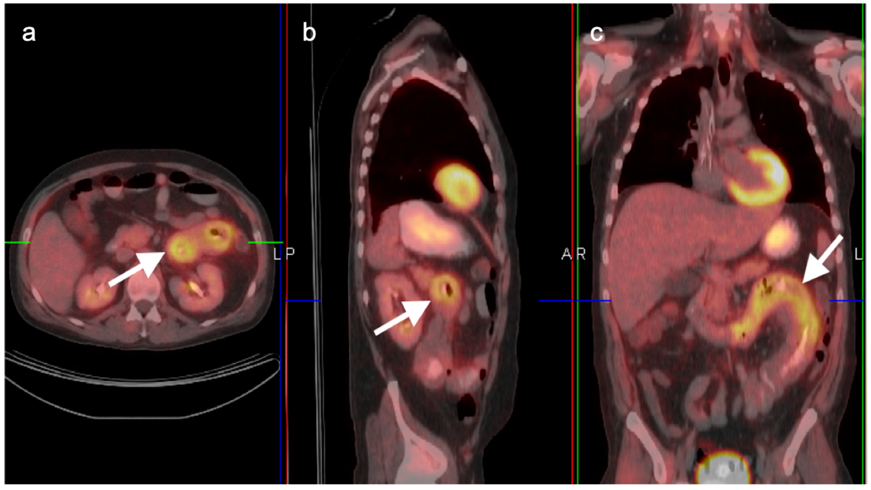 pet scan colon cancer