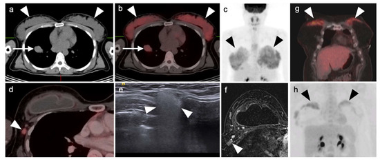 PET-CT in Clinical Adult Oncology: II. Primary Thoracic and Breast ...
