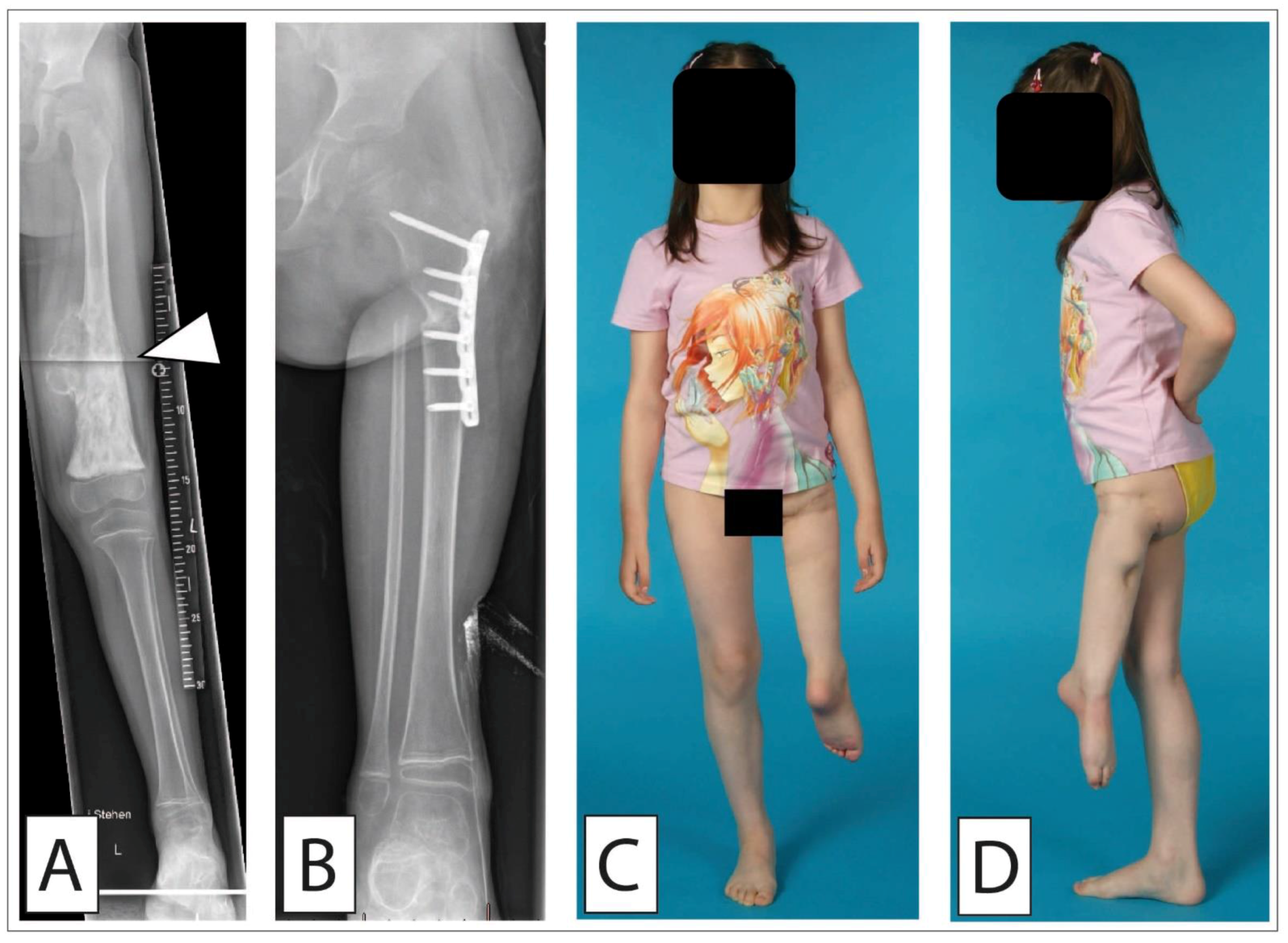 Cancers | Free Full-Text | Surgical Treatment of Bone Sarcoma