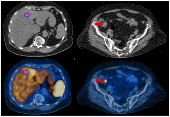 内科診断学 = MEDICAL DIAGNOSIS Preclinical Evaluation and Pilot Clinical Study of CD137 PET