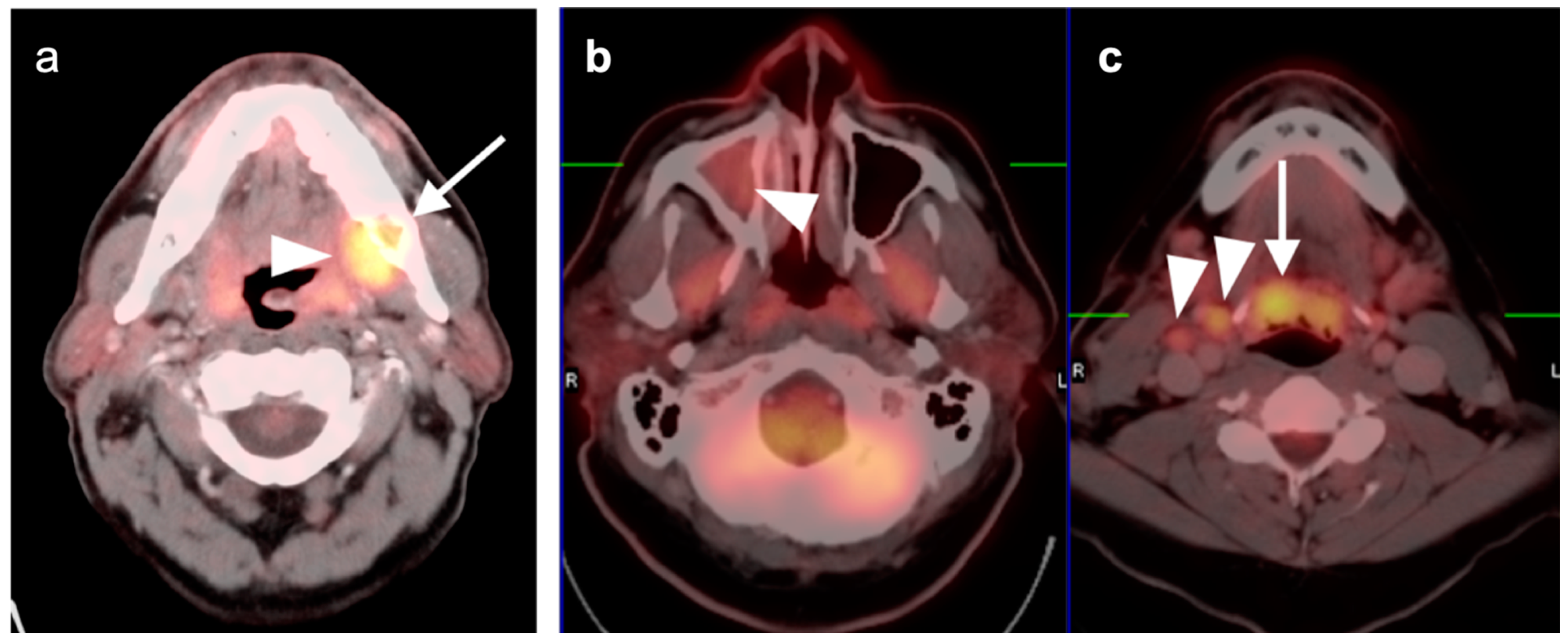 Soft, symmetrical, bulky tumors on the back