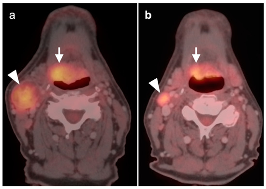 健康・医学 PET in Clinical Oncology PET-CT in Clinical Adult Oncology: II. Primary Thoracic and