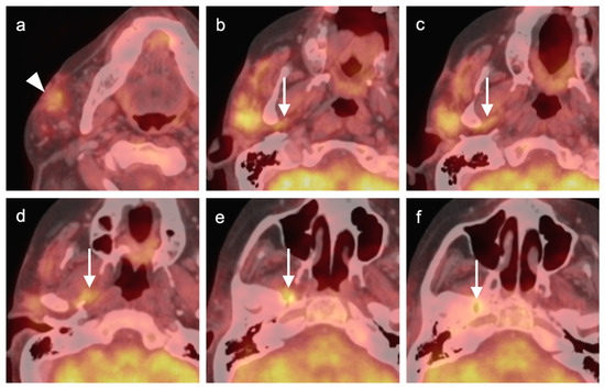 PET-CT in Clinical Adult Oncology—V. Head and Neck and Neuro Oncology