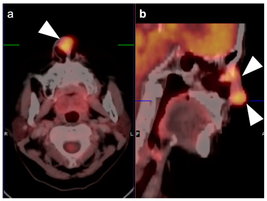PET-CT in Clinical Adult Oncology—V. Head and Neck and Neuro