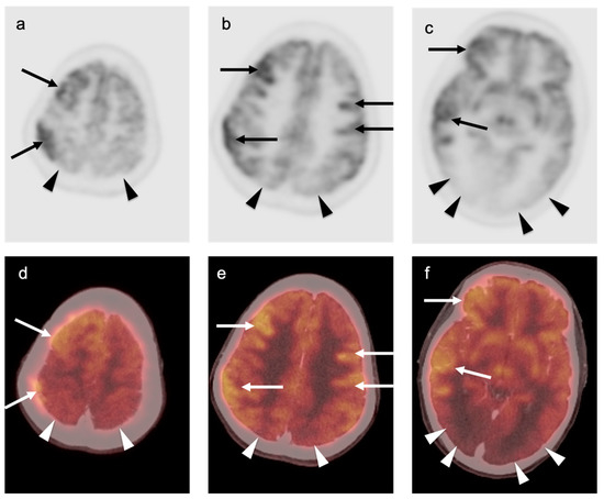 PET-CT in Clinical Adult Oncology—V. Head and Neck and Neuro