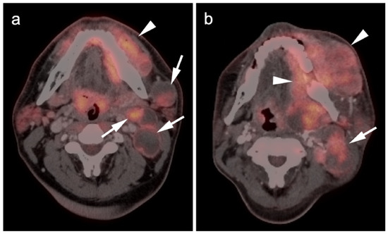 PET-CT in Clinical Adult Oncology—VI. Primary Cutaneous Cancer ...