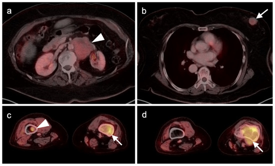 PET-CT in Clinical Adult Oncology—VI. Primary Cutaneous Cancer ...