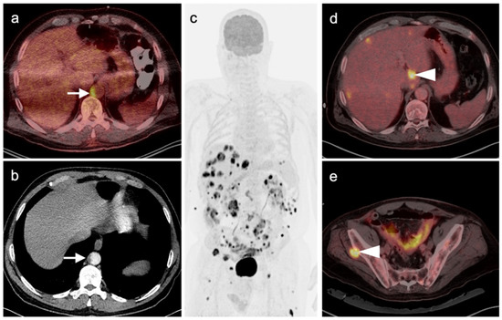 PET-CT in Clinical Adult Oncology—VI. Primary Cutaneous Cancer ...
