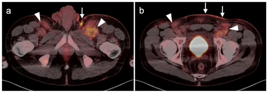 PET-CT in Clinical Adult Oncology—VI. Primary Cutaneous Cancer ...