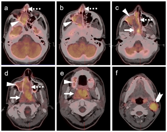 PET-CT in Clinical Adult Oncology—VI. Primary Cutaneous Cancer ...