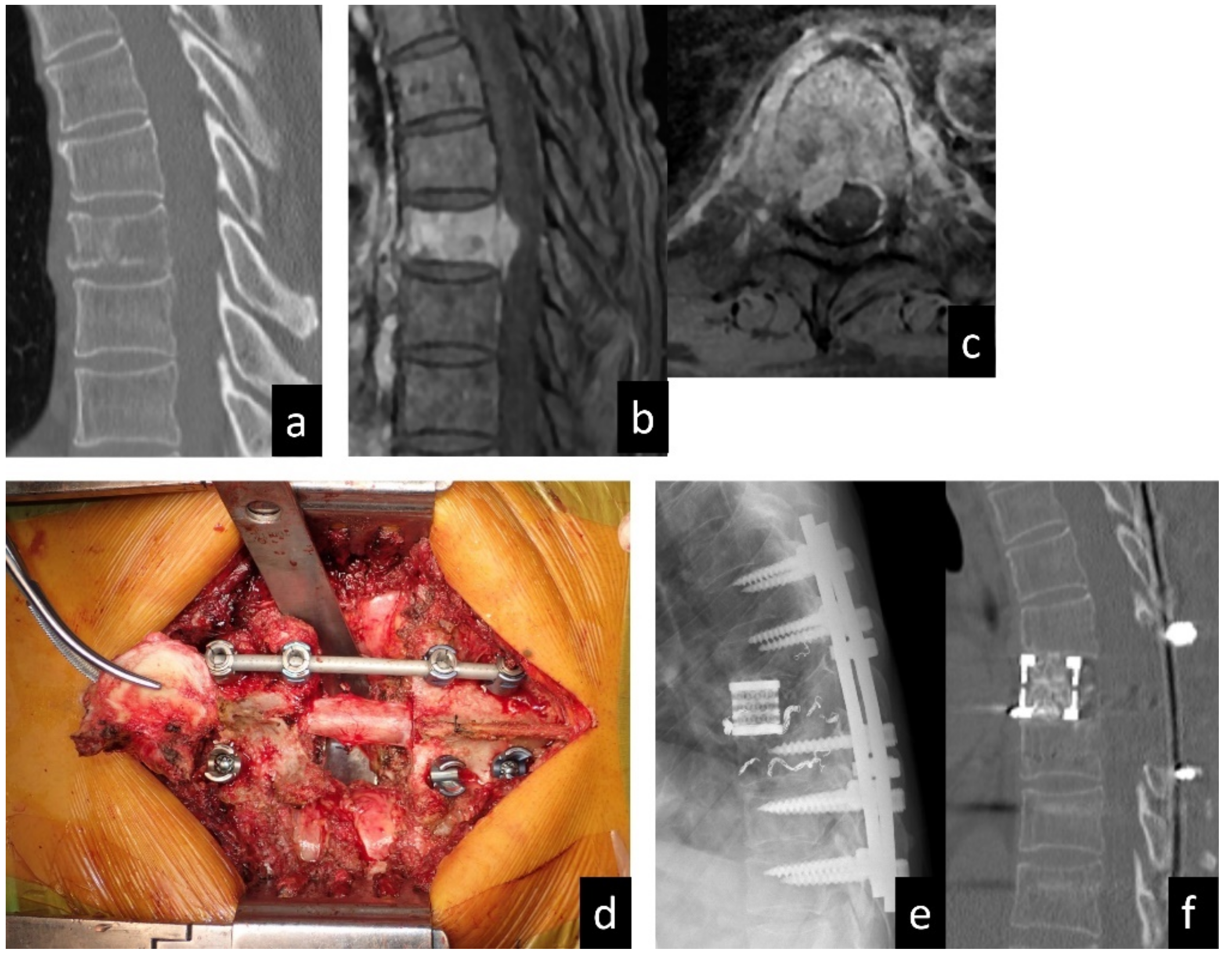 国産品 Clinical Long-Term to Medium Outcomes Metastasectomy Spinal of 健康・医学