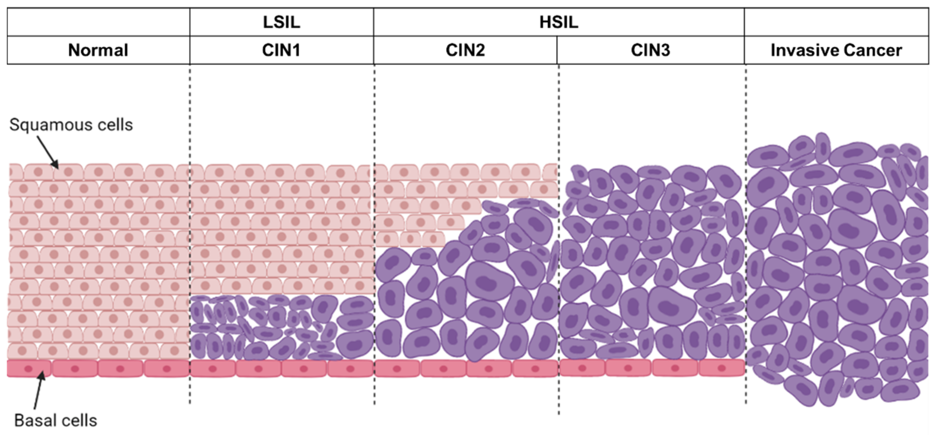 Интраэпителиальное поражение hsil. Дисплазия шейки матки Cin 1.
