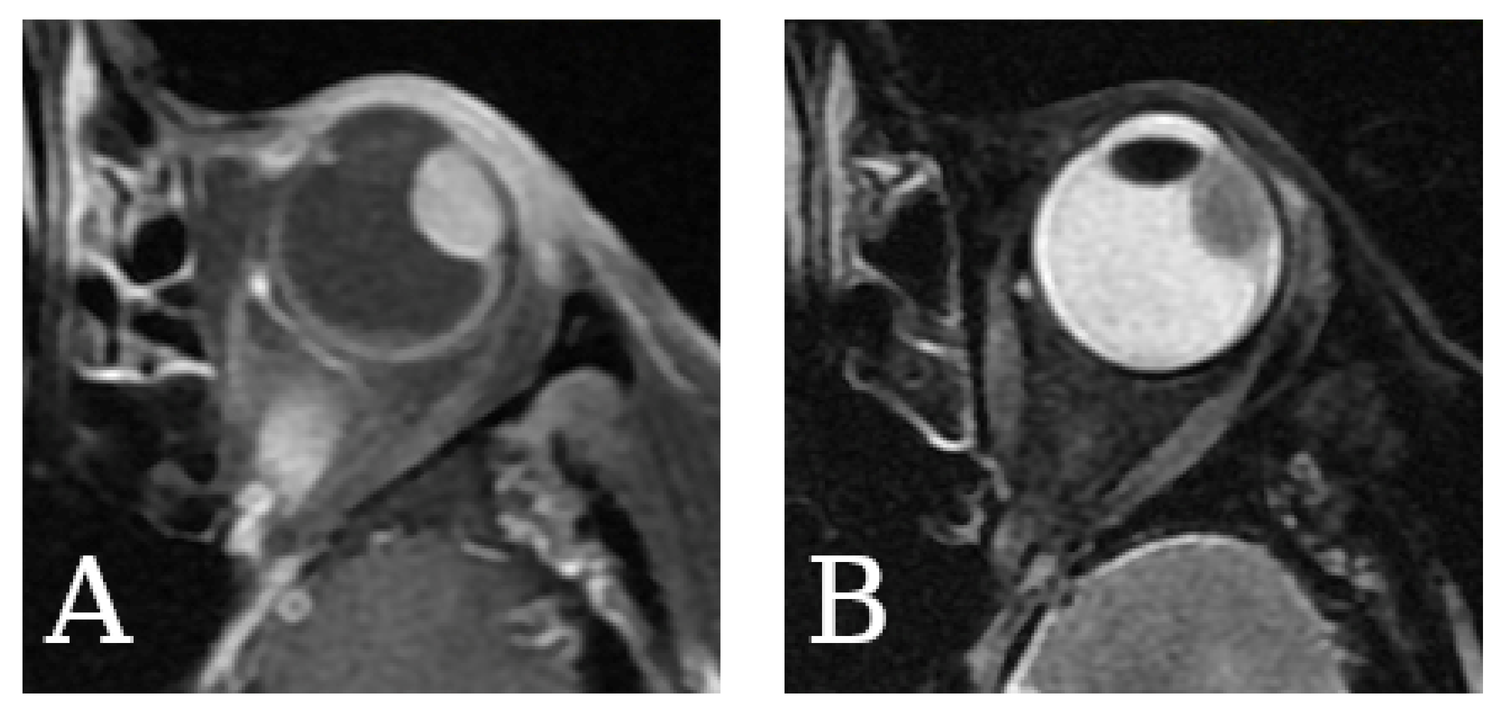 Cancers Free FullText Imaging of Uveal Melanoma—Current Standard