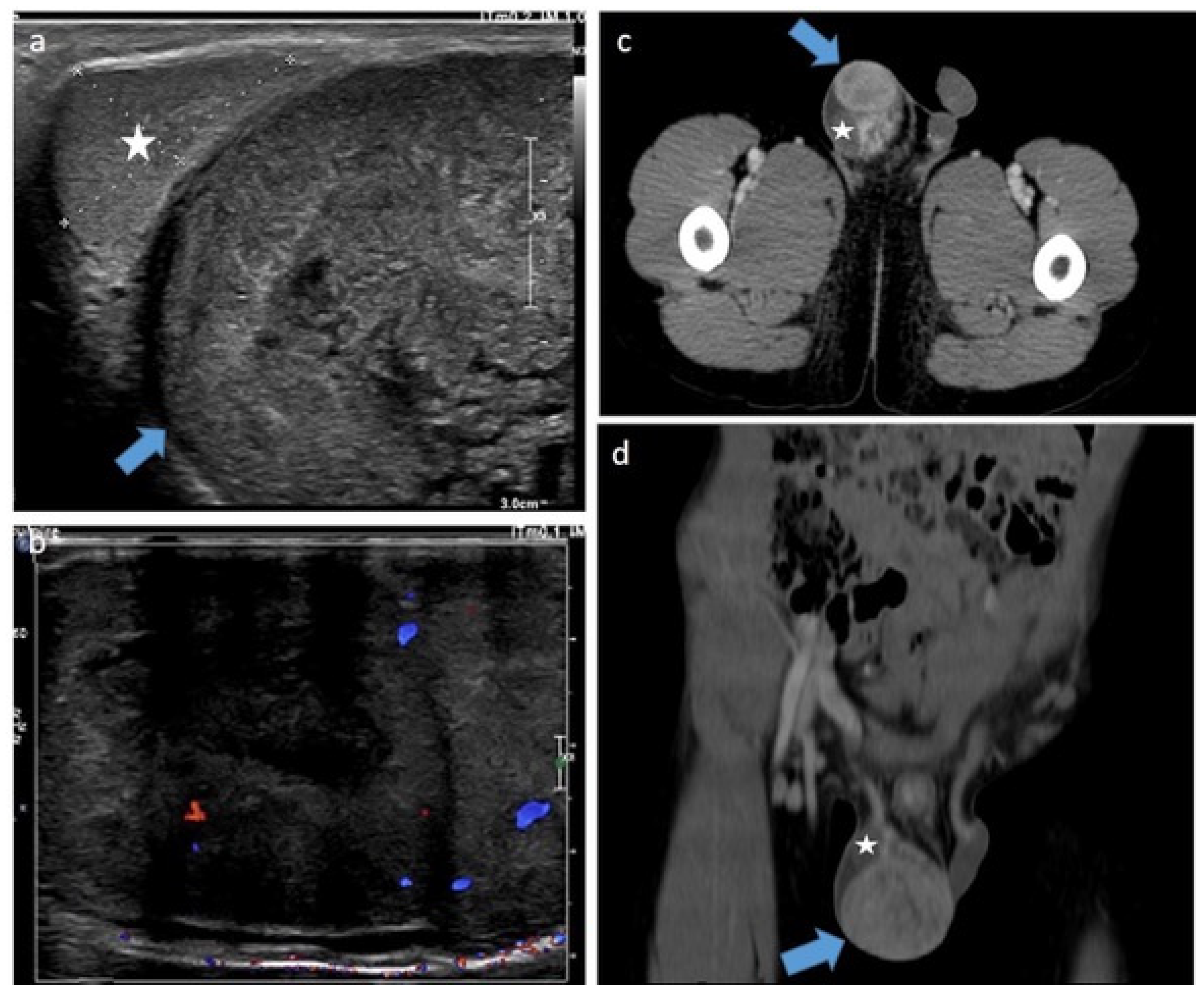 Testicular Cyst Vs Cancer