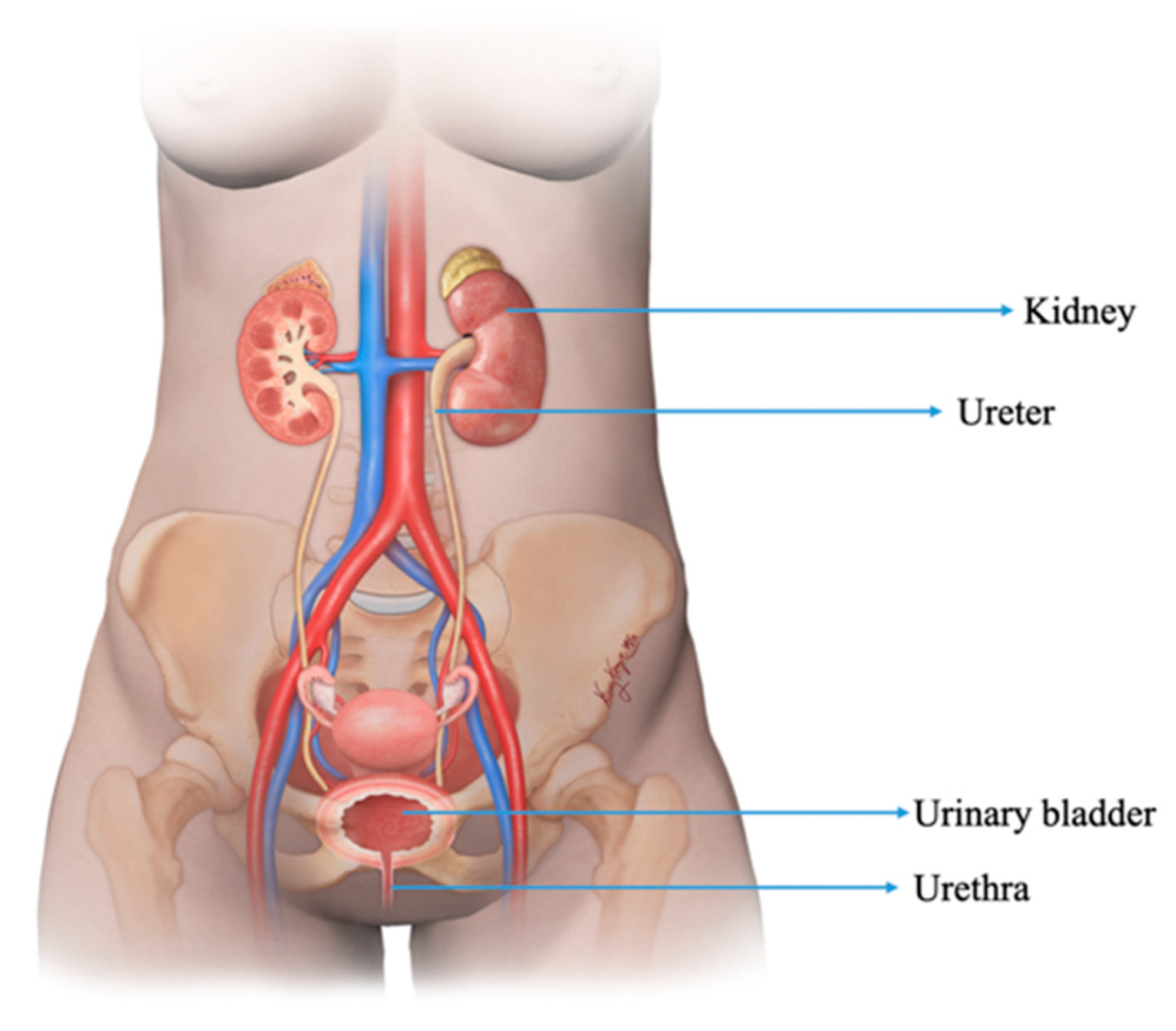 Woman suffering from low back pain with kidney anatomy shape. Cause of flank  pain include urinary tract infection, kidney infection, kidney stone, an  injury or kidney cancer. Nephrology concept. Stock Photo