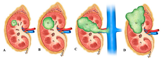 Neuroendocrine Neoplasms of the Female Genitourinary Tract