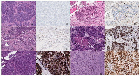 Neuroendocrine Neoplasms of the Female Genitourinary Tract